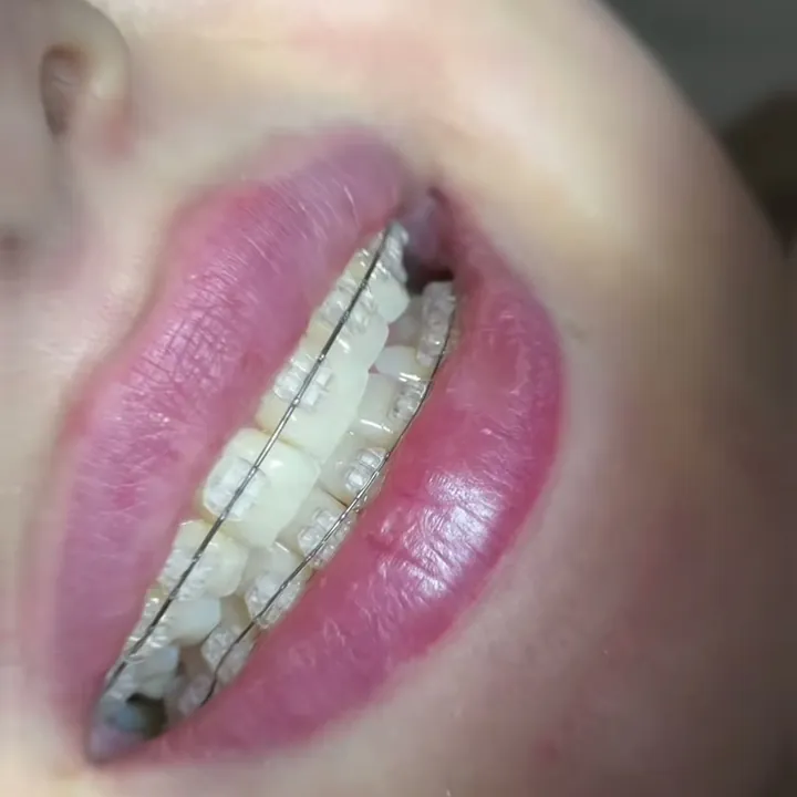 Zâmbet cu aparat dentar fix.