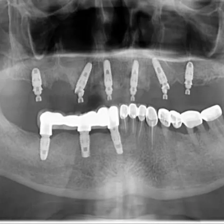 Radiografie publicată de clinică: lucrare fixă pe implanturi.