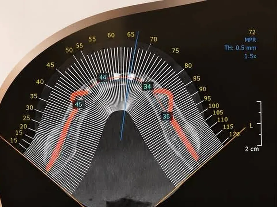 Planificarea implanturilor pe radiografia 3D, dintr-o postare a clinicii.